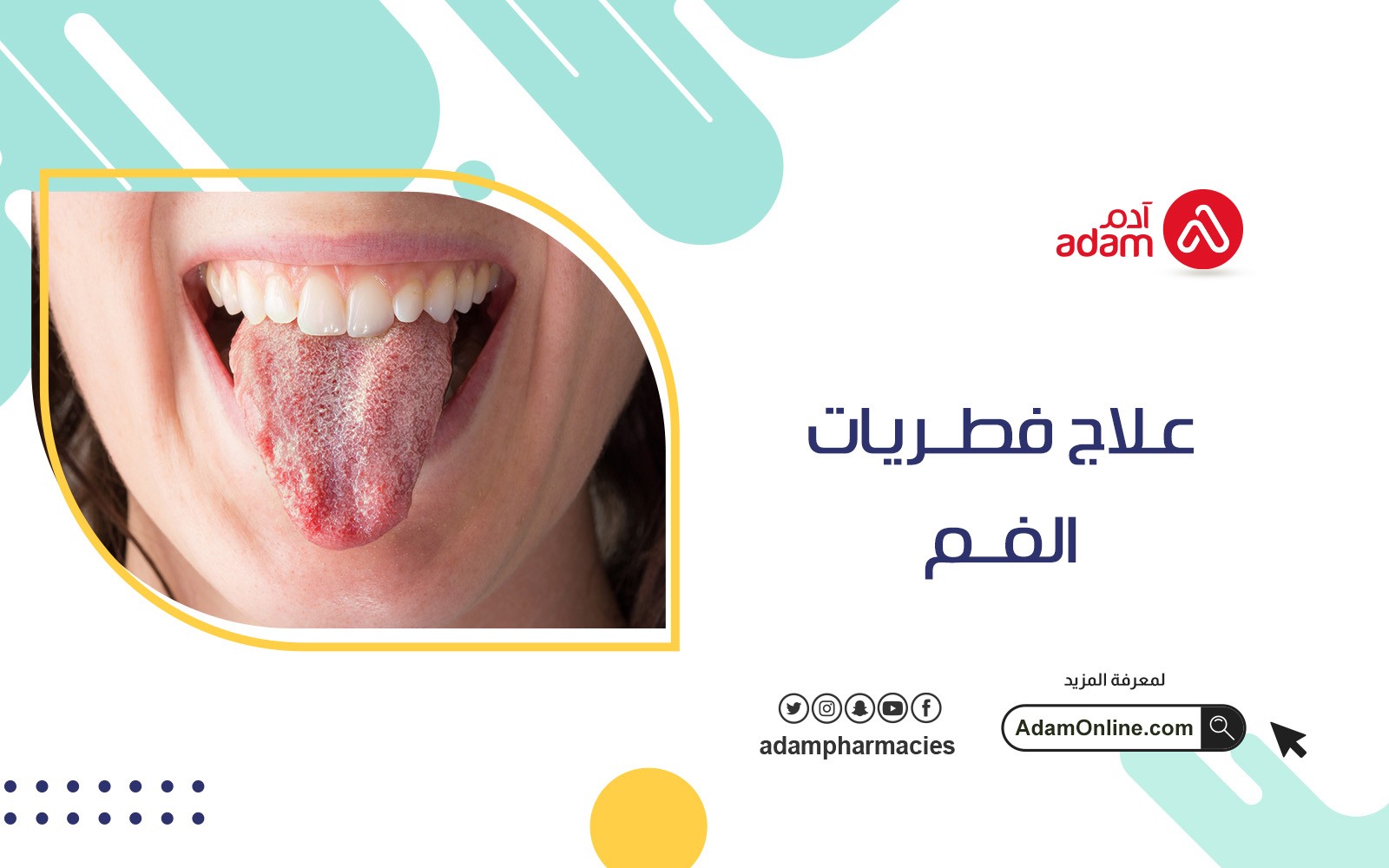 علاج فطريات الفم